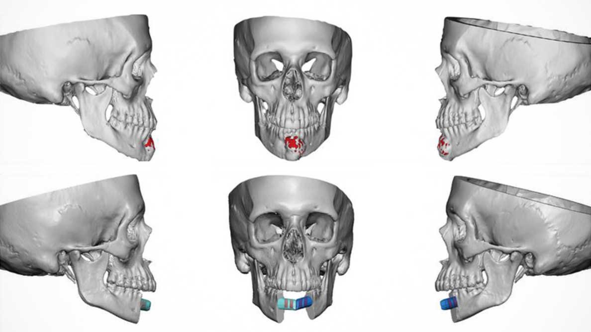 jaw in a day